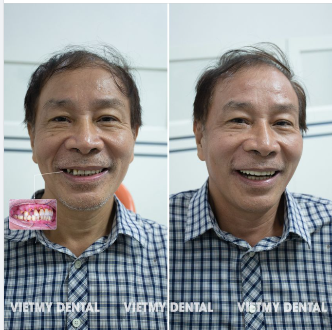 Chú Toàn sinh sống tại Cầu Giấy đến với nha khoa trong tình trạng bị mất răng ở cả 2 hàm ảnh hưởng nghiêm trọng đến việc ăn uống.