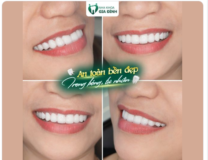 THẨM MỸ RĂNG SỨ - AN TOÀN BỀN ĐẸP, TRONG BÓNG TỰ NHIÊN