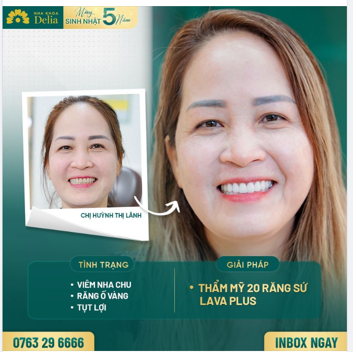 Sở hữu nụ cười đều đẹp - trắng sáng sau 48h làm thẩm mỹ răng sứ