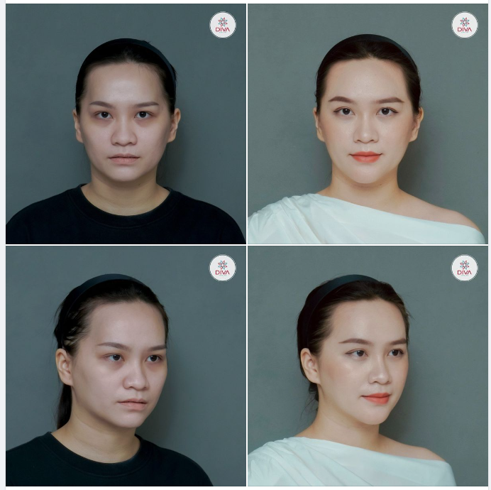 KẾT QUẢ THẨM MỸ SAU 1 THÁNG TIÊM MỠ COLEMAN MẶT: GƯƠNG MẶT MỀM MẠI TƯƠI TRẺ