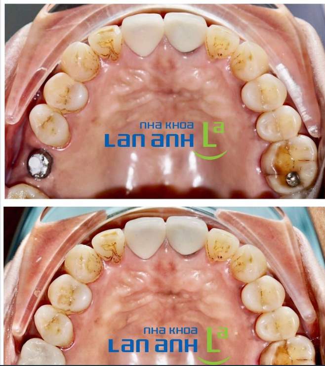 Hình ảnh một trường hợp mất răng 16 được Bác sĩ tư vấn đặt trụ Implant MIS C1 tại chi nhánh Huỳnh Văn Bánh, Phú Nhuận.