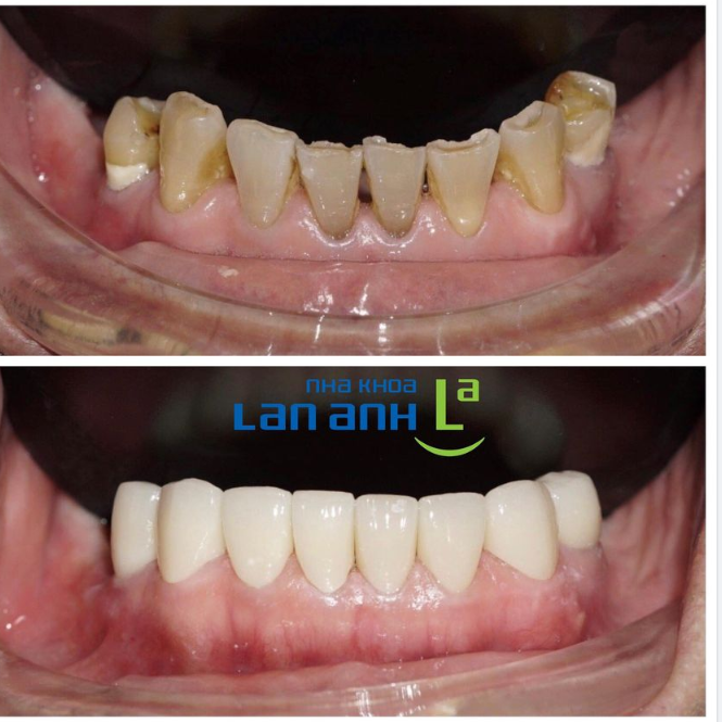 Hình ảnh một trường hợp bị mòn mặt nhai răng 34-44, được Bác sĩ Trần Hoài Nam- chi nhánh Phú Nhuận tư vấn phục hình răng sứ Cercon phục hồi men răng giúp khách hàng ăn nhai tốt hơn và thẩm mỹ hơn.