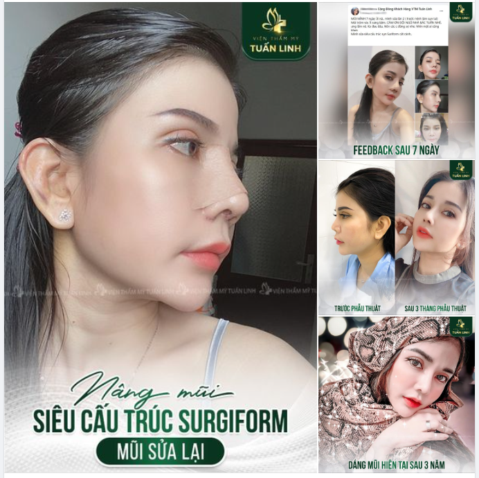 Feedback Nâng mũi siêu cấu trúc sửa lại Surgiform - Dáng mũi sau 3 năm.