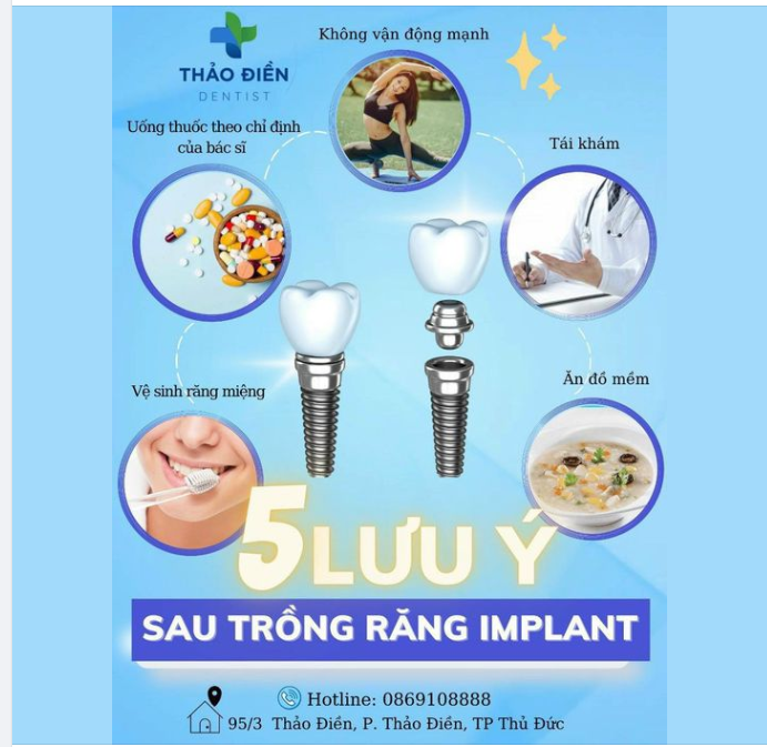 Bỏ túi 5 lưu ý sau khi trồng răng Implant để có được kết quả phục hình răng hoàn hảo nhất nhé!