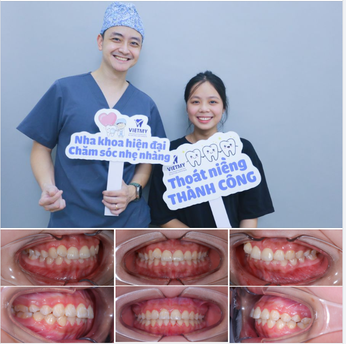 Chỉ sau 16 tháng, răng của em đã trở nên đều như hạt bắp, đường giữa đã cân đối hoàn hảo và khớp cắn cũng đã trở về vị trí chuẩn.