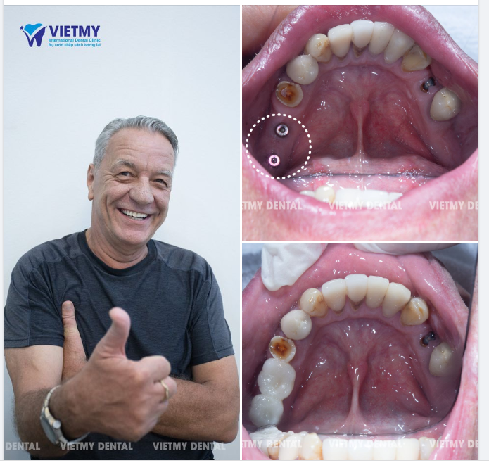 Hoàn thành lắp răng cho vị khách người Australia- ông Cris Vorwerg hiện đang sinh sống tại Hà Nội.