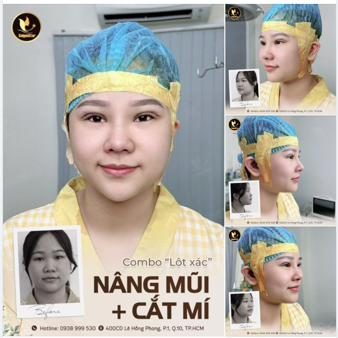 COMBO LỘT XÁC: NÂNG MŨI + CẮT MÍ MẮT