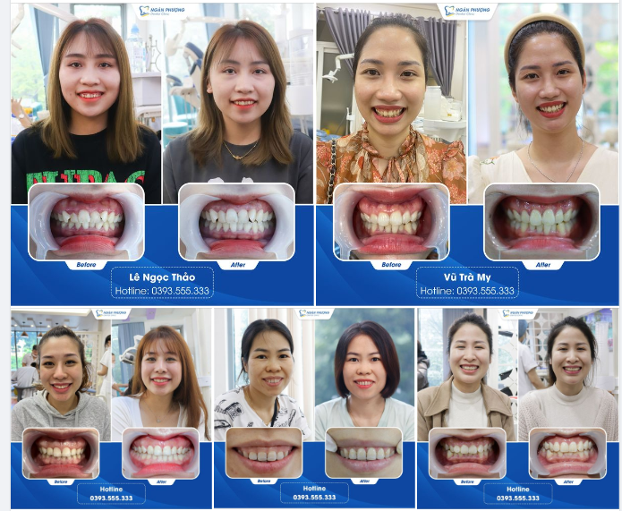 Lật vạt cắt lợi không chỉ giúp hết cười hở lợi mà còn có thể kết hợp mài xương ổ răng, giảm tình trạng hô. Khác với cắt lợi bằng laser, phương pháp này không bị lợi bò, hở lợi trở lại.