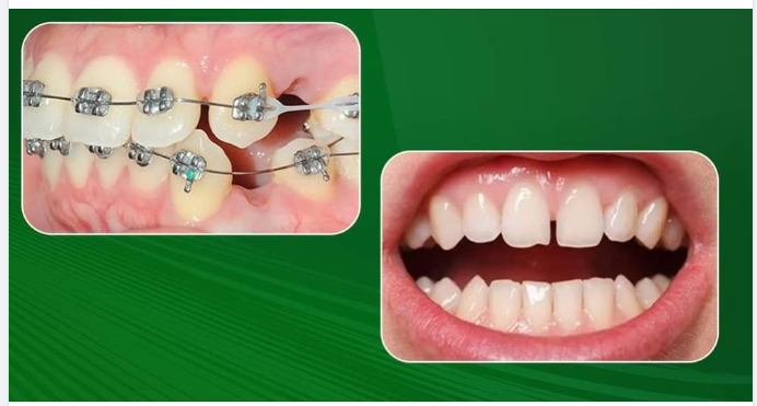 THÁO NIỀNG RỒI CŨNG ĐỪNG VỘI "BUNG XÕA"