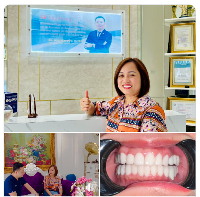 Chia sẻ của chị BN việt kiều từ cộng hòa Séc về làm 2 hàm răng sứ thẩm mỹ, nhổ răng và cấy tức thì 5 cây Implant tại NHA KHOA PHƯƠNG ANH