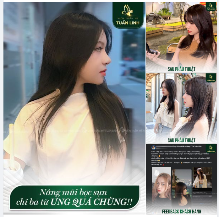 Chị em muốn nâng mũi đẹp nhẹ nhàng tự nhiên mà không kém phần sắc nét thì tham khảo dáng mũi Sline này bên em nhé.
