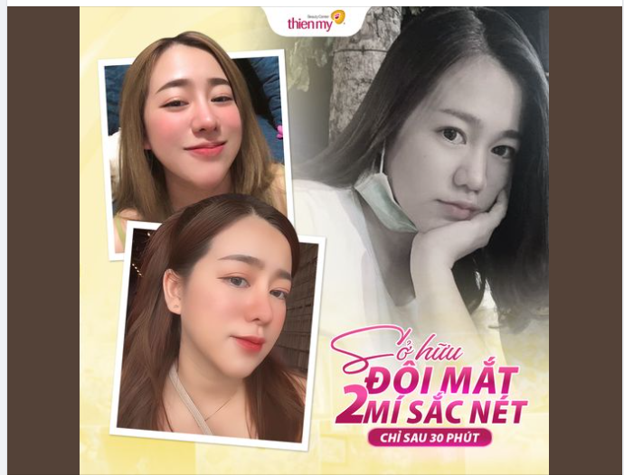 Đầu tư 30 phút =Sở hữu đôi mắt 2 mí đều đẹp, to tròn cho khuôn mặt thêm phần thu hút!