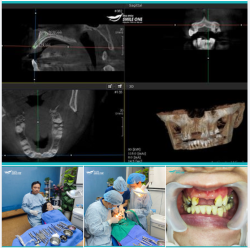Trồng răng implant R11 R21 khách hàng Ngọc Mai 38 tuổi