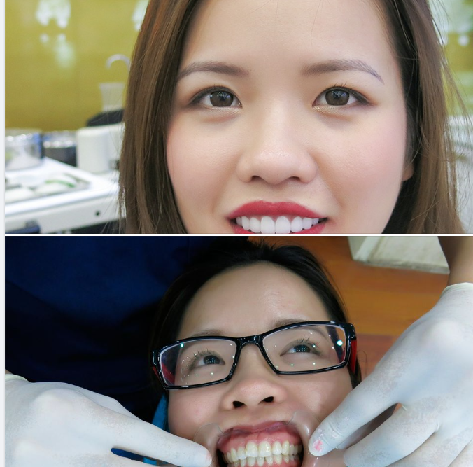 Các Vấn Đề Thường Gặp Sau Khi Trồng Răng Sứ Và Cách Khắc Phục