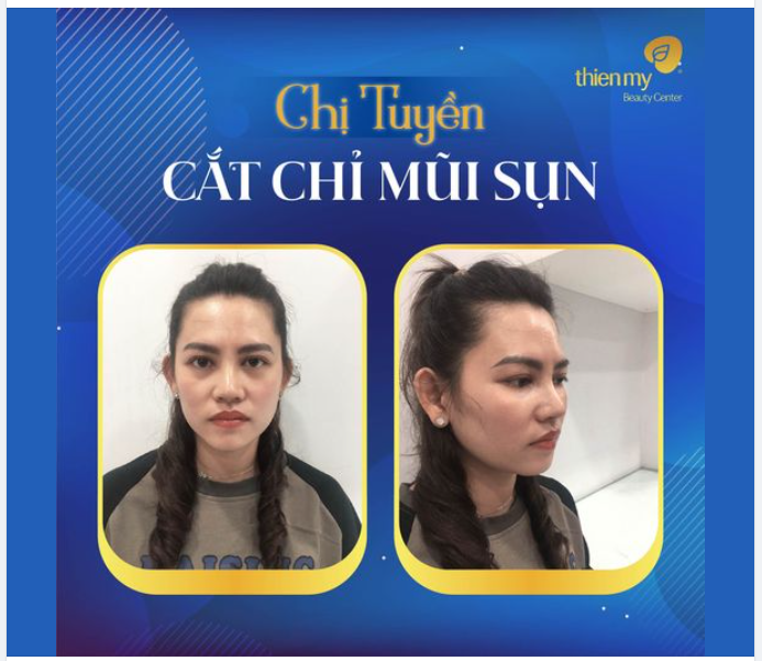 ĐẸP HẾT NƯỚC CHẤM LUÔN ​​​​​​​ Feedback chị Tuyền cắt chỉ mũi sụn