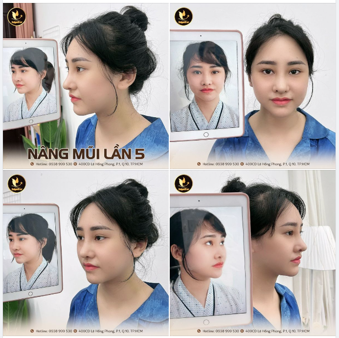 NÂNG MŨI LẦN 5