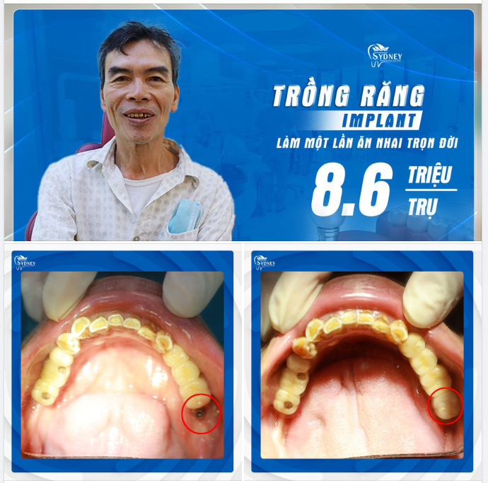 TRỒNG RĂNG IMPLANT - TRỌN VẸN HẠNH PHÚC TUỔI GIÀ