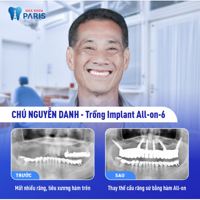 TRỒNG IMPLANT ALL-ON 6 PHỤC HÌNH RĂNG MẤT HÀM TRÊN