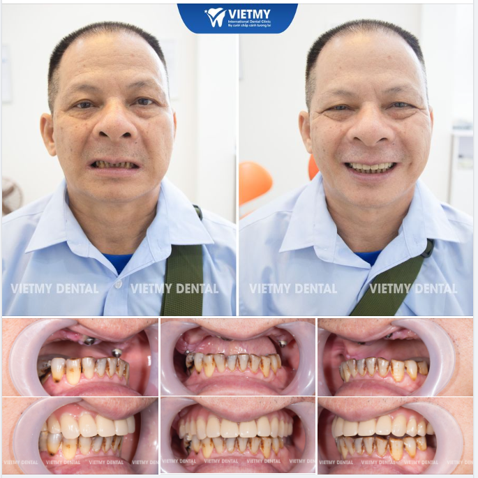 Hoàn thành ca lắp răng cố định toàn hàm cho chú Mạnh đến từ Sơn La.