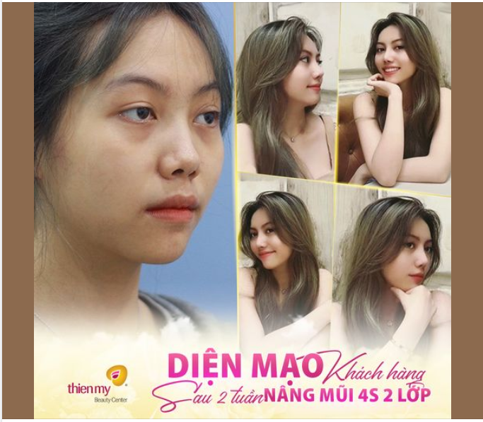 Nâng mũi xong, không cần trang điểm mỗi ngày, mặt mộc vẫn đẹp và thần thái