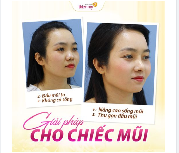 Dáng mũi khách hàng sau 1 tháng thực hiện dịch vụ nâng mũi tại VTM Thiện Mỹ