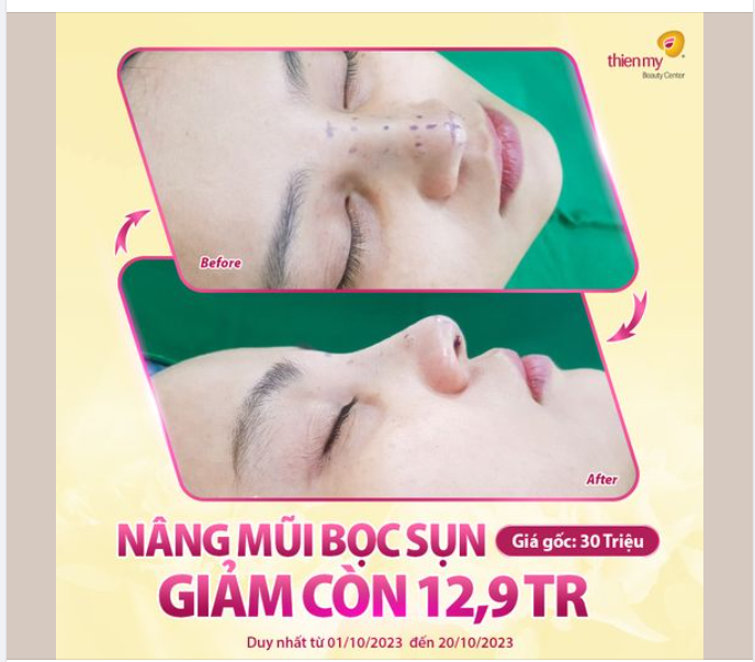 HÌNH ẢNH KH TRƯỚC VÀ SAU KHI VỪA NÂNG MŨI XONG