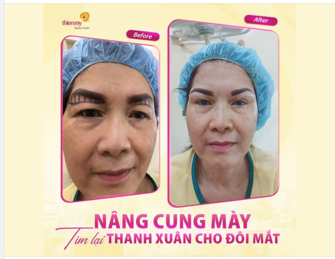 TREO CUNG MÀY – TÌM LẠI THANH XUÂN CHO ĐÔI MẮT