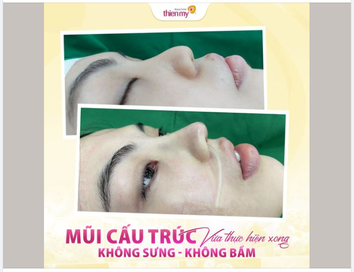 MŨI ĐẸP TOÀN DIỆN SAU 60P THỰC HIỆN NÂNG MŨI