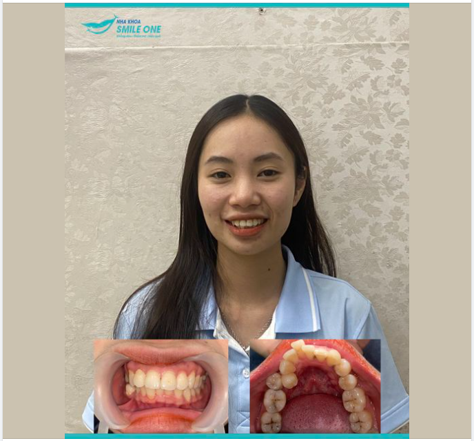 Chào mừng Huyền Diệp đến với Team niềng răng Smile One!