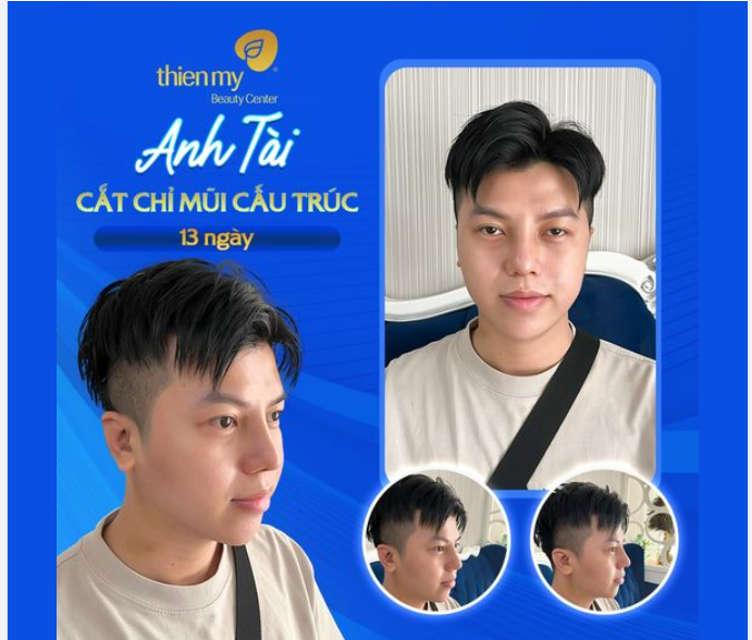 Anh Tài - Cắt chỉ Mũi cấu trúc sau 13 ngày