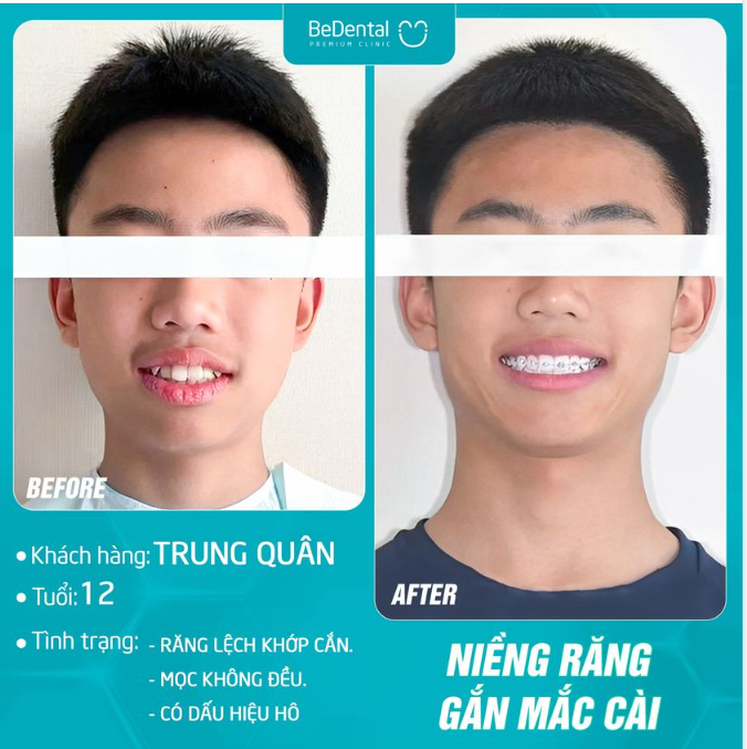 CON BỊ RĂNG HÔ, MÓM, THƯA, KHẤP KHỂNH,....  PHỤ HUYNH CẦN LÀM GÌ?