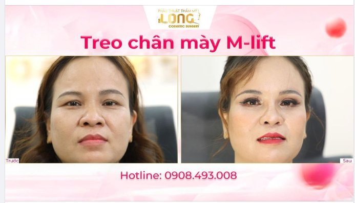 TREO CHÂN MÀY M-LIFT SHIP NGAY SỰ TRẺ TRUNG