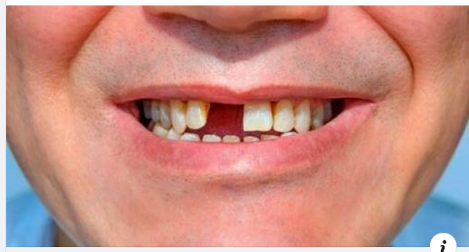 Không trồng răng giả sau khi nhổ răng có sao không?