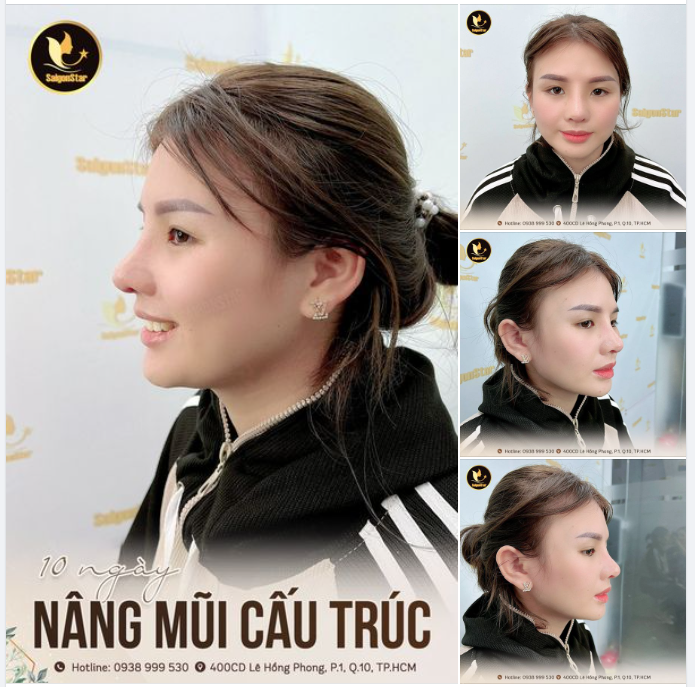 10 NGÀY NÂNG MŨI CẤU TRÚC ĐẸP CHUẨN HOT GIRL