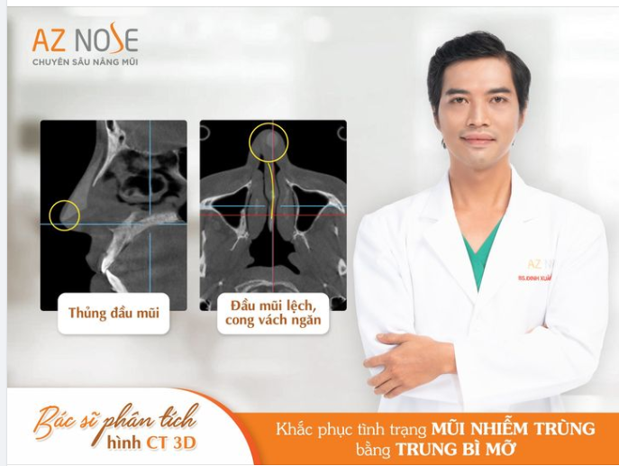 Bác sĩ phân tích hình CT 3D. Khắc phục mũi h.ỏng cho KH đến từ Cần Thơ