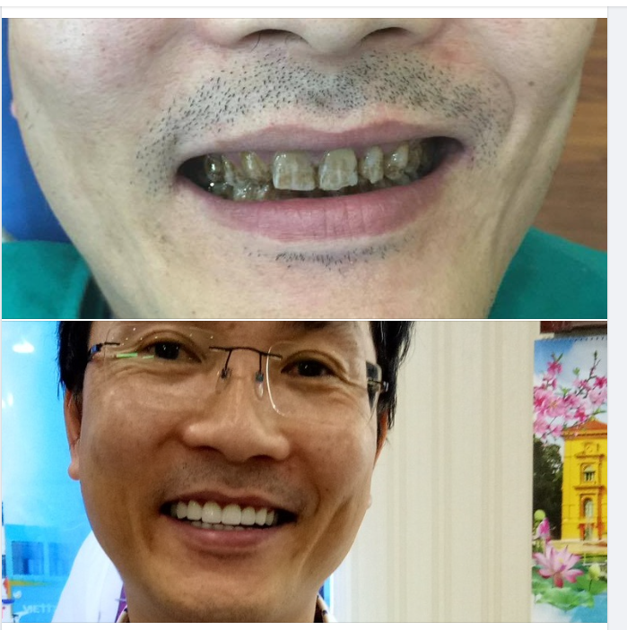 Bọc răng sứ hay dán sứ Veneer tốt – mỗi nơi tư vấn một kiểu