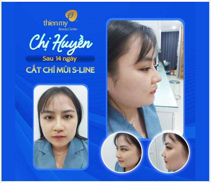 Đầu tư cho bản thân là một cách đầu tư có lời lớn nhất đó các nàng ạ" - Chia sẻ của chị Huyền sau 14 ngày cắt chỉ mũi S-Line tại Thiện Mỹ.