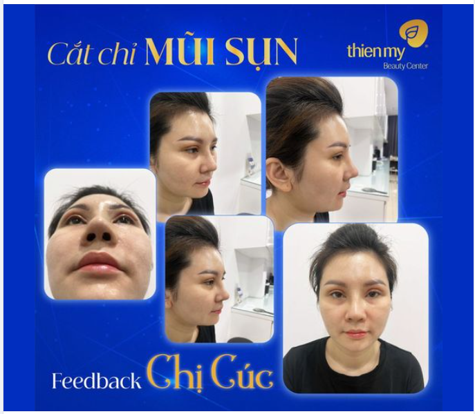 Feedback của chị Cúc sau khi cắt chỉ mũi sụn tại Thiện Mỹ