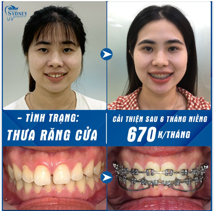 THAY ĐỔI NỤ CƯỜI CHỈ SAU 6 THÁNG!
