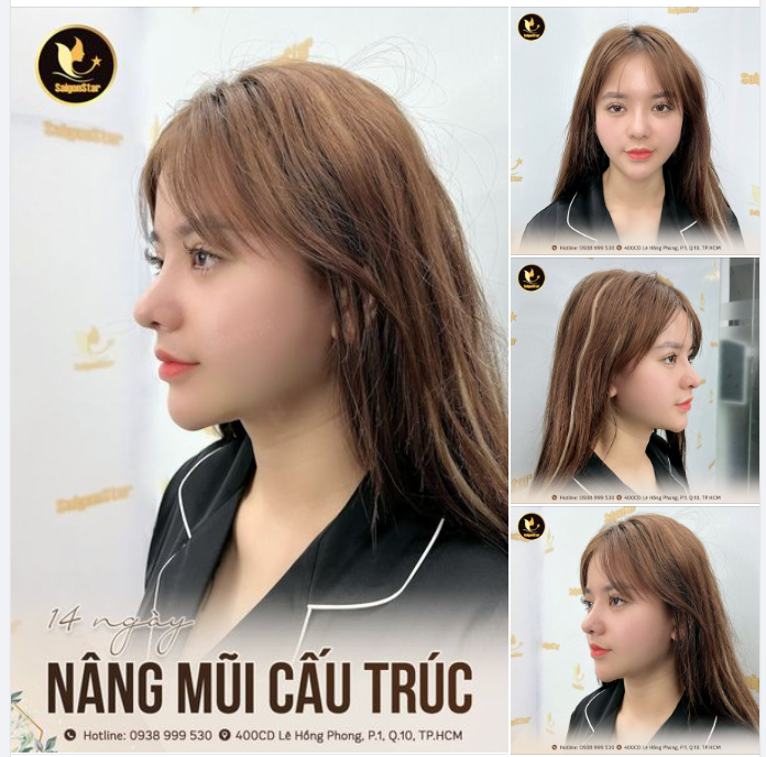 Người thật việc thật – Khách hàng nâng mũi tại Bác sĩ Hoạt