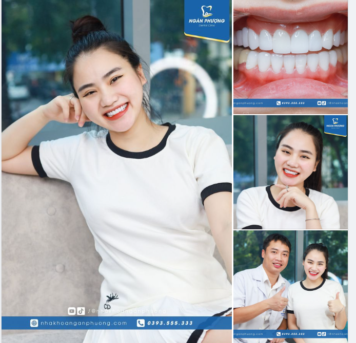 Cảm ơn Mỹ Hạnh đã tin tưởng trao gửi nụ cười nơi bác sĩ Tuấn nhân dịp đặc biệt này. Hẹn bạn tái khám thường xuyên để giữ răng miệng luôn khỏe mạnh nhé