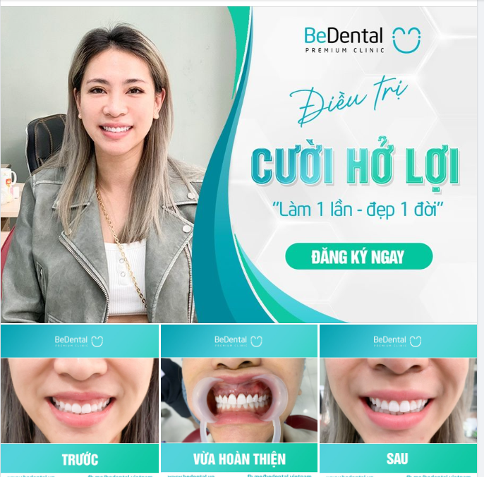 ĐIỀU TRỊ CƯỜI HỞ LỢI - VẼ LẠI NỤ CƯỜI DUYÊN