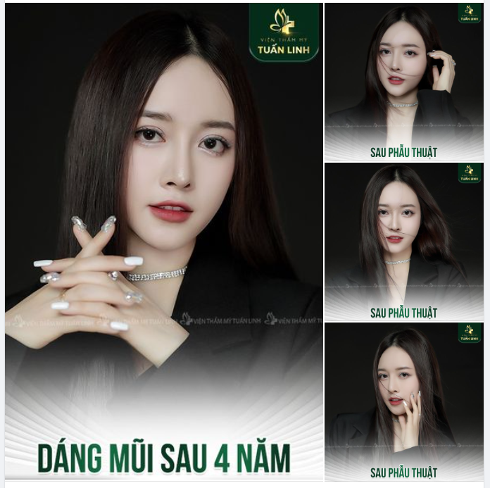 Khoe nhẹ chiếc mũi siêu xinh sau 4 năm nâng tại Tuấn Linh!!