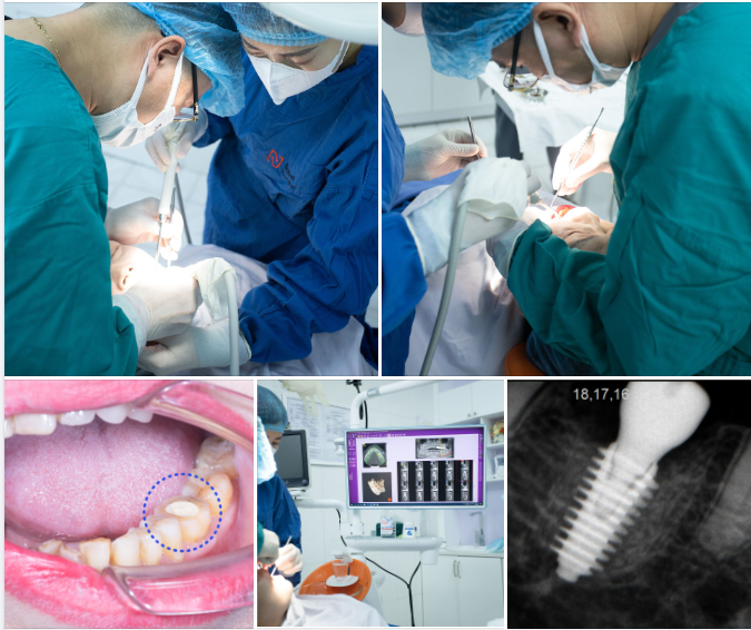 Cô Thảo hiện đang sinh sống tại Ninh Bình, đến với nha khoa trong tình trạng bị đau nhức R36 sau 1 thời gian điều trị tủy tại nơi khác.