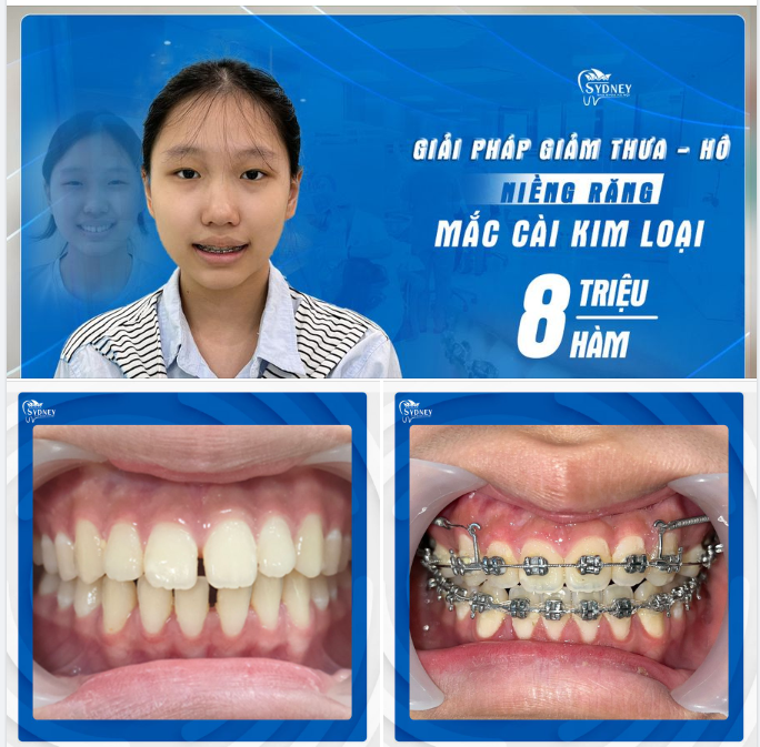 NIỀNG RĂNG – GIẢI PHÁP KHẮC PHỤC THƯA, HÔ