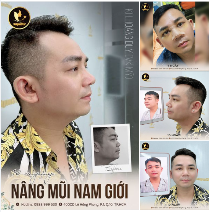 10 NGÀY NÂNG MŨI NAM GIỚI