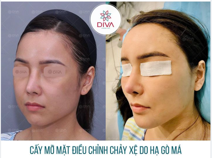 HẠ GÒ MÁ XONG, MẶT GẬP GHỀNH CHẢY XỆ XUỐNG? NGUYÊN NHÂN DO ĐÂU ?