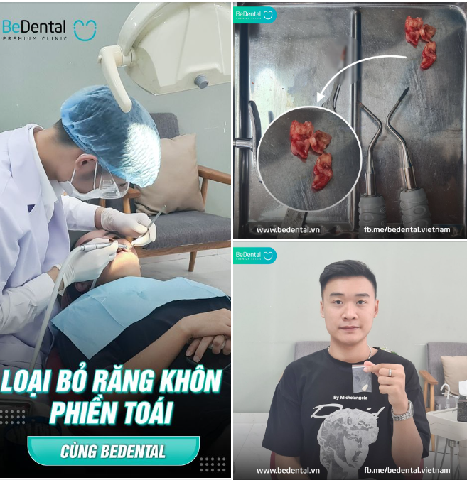 NHỔ RĂNG KHÔN KHÔNG ĐAU CÓ THẬT KHÔNG?