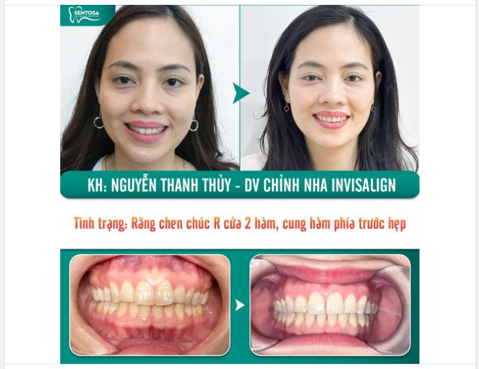 THÀNH QUẢ XỨNG ĐÁNG SAU HƠN 18 THÁNG NIỀNG RĂNG INVISALIGN