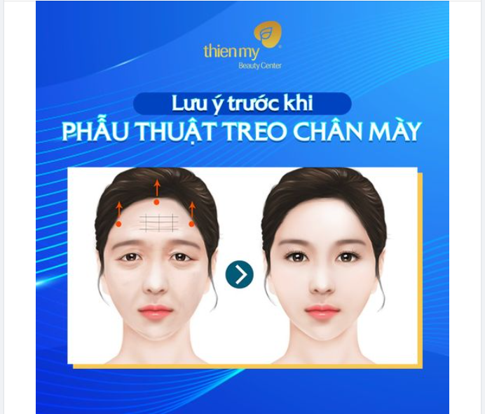 Lưu ý trước khi phẫu thuật treo chân mày